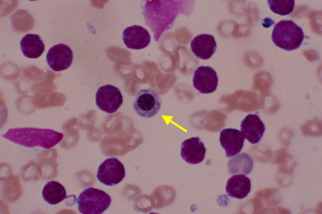 abnormal white blood cell levels