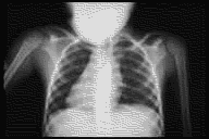 child_lung_x-ray.gif (6199 bytes)